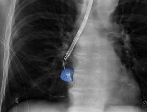Lung biopsy